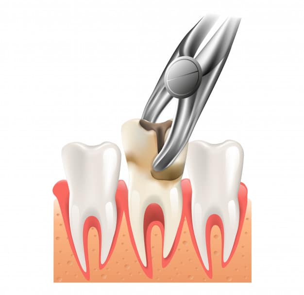 Kako zaustaviti krvarenje nakon vađenja zuba – upute nakon vađenja – artDENTAL
