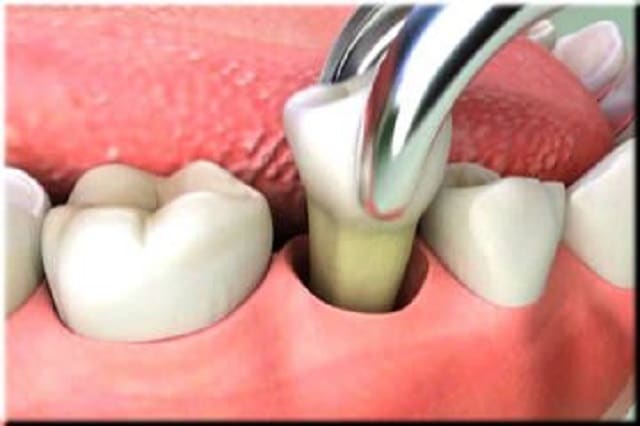 Zarastanje zubnog mesa nakon vađenja zuba – faze zarastanja – artDENTAL