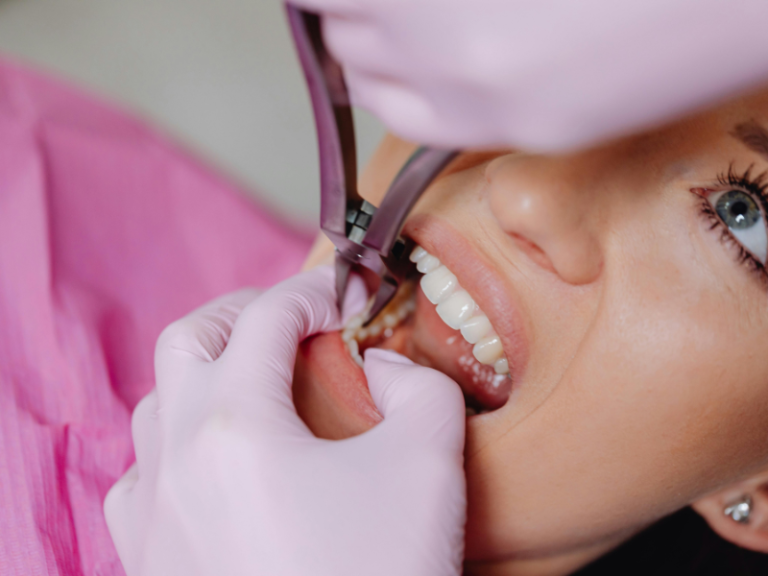 Zarastanje zubnog mesa nakon vađenja zuba – vrste vađenja – faze zarastanja – artDENTAL