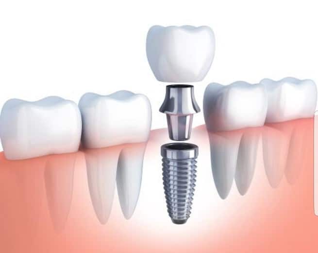 Vađenje zubnog implantata