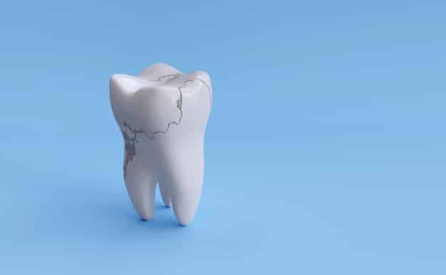 Puknuti zub – što učiniti – kako liječiti – artDENTAL